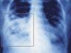 Elhúzódó köhögés is jelezheti a tüdőgyulladást