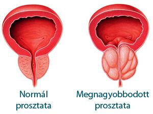 Rosszindulatú prosztata-megnagyobbodás