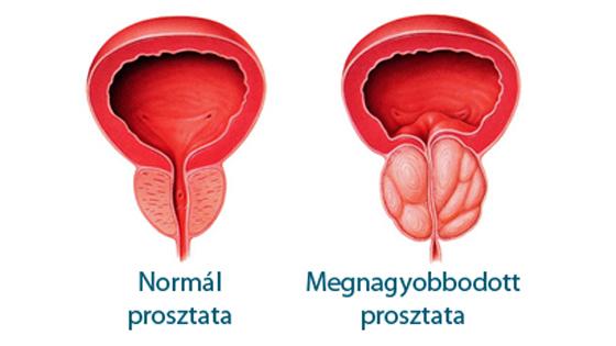 Rosszindulatú prosztata-megnagyobbodás