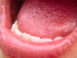 Égő száj szindróma